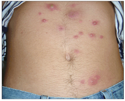 Staphylococcal Infections: MedlinePlus