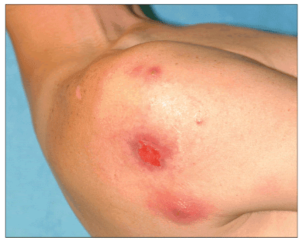Cellulitis and Abscess in an IV Drug User by Stacey ...